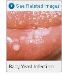 Yeast Infection in Baby