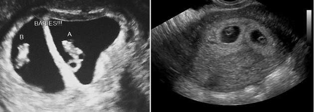 5 weeks ultrasound twins pictures