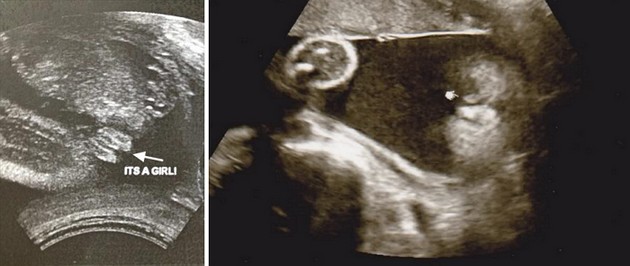 30 Week Ultrasound Girl