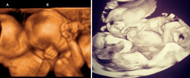 28 weeks ultrasound twins pictures