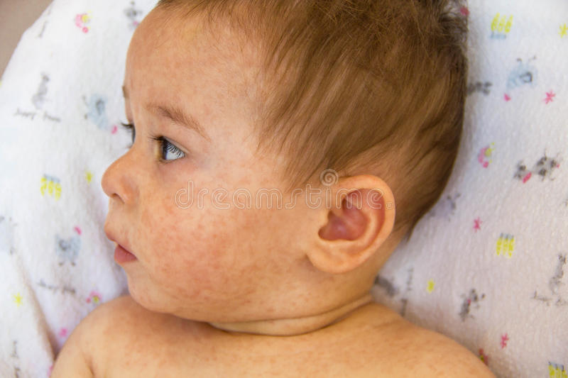 baby skin rash atopic dermatitis