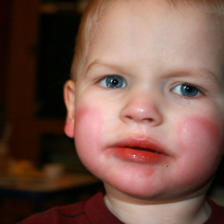 hives in babies face