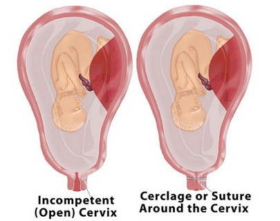 cervical cerclage types
