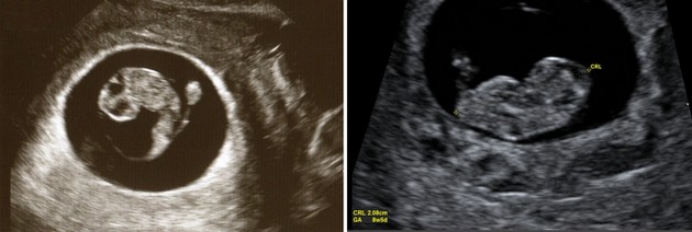 8 weeks ultrasound photo