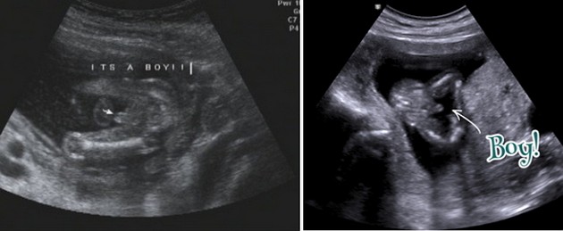 15 Week Ultrasound Boy