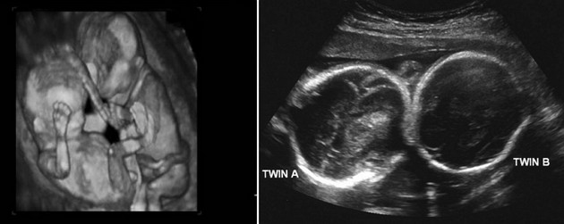 23 weeks ultrasound twins pictures