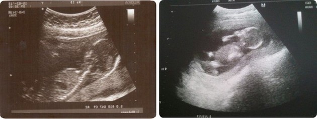 Pregnancy 15 Weeks Ultrasound