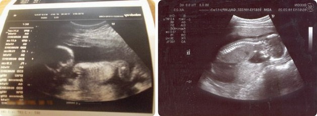 17 Weeks Pregnant 4