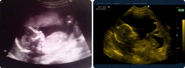 18 Weeks Pregnant 3