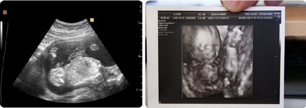 20 Weeks Pregnant 4