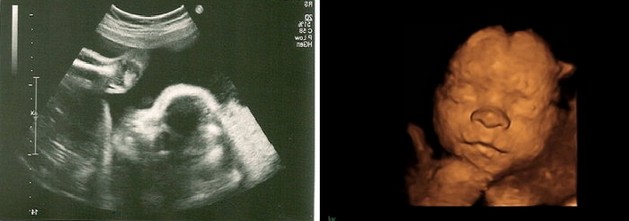 26 Weeks Pregnant 1