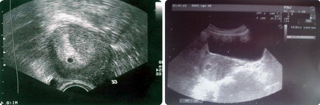Ultrasound 4 weeks 3 days