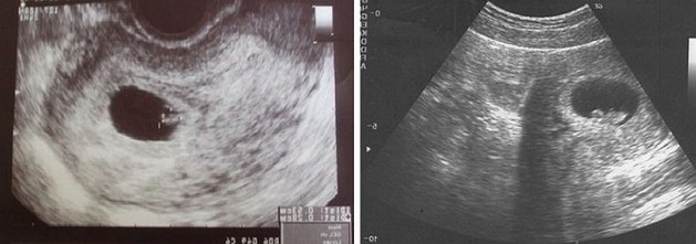 7 Weeks Pregnant 3