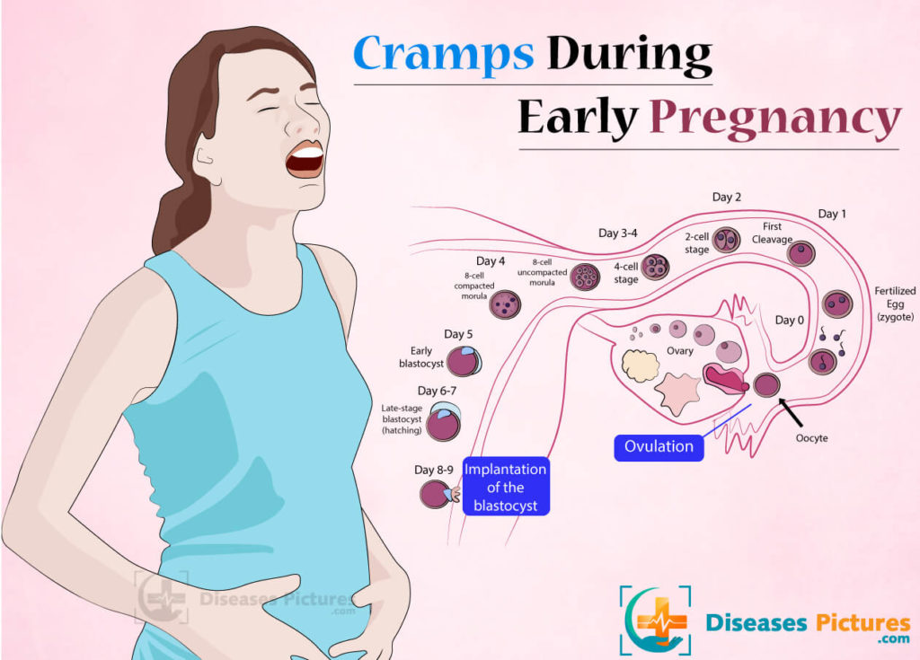 Cramping In Early Pregnancy