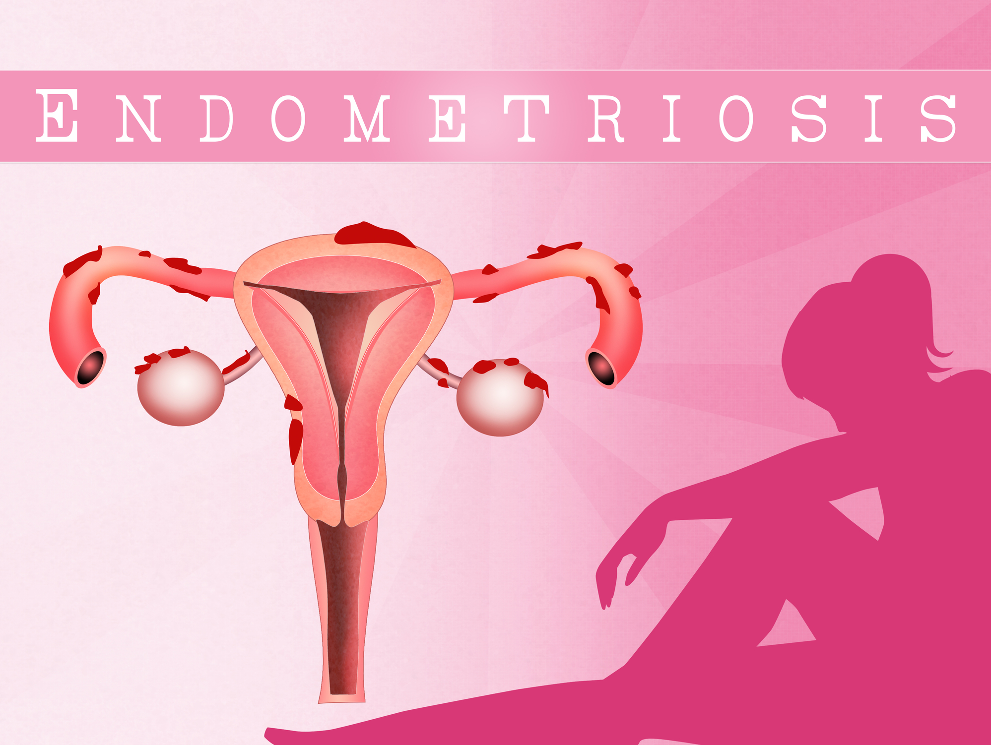 Endometriosis And Pregnancy