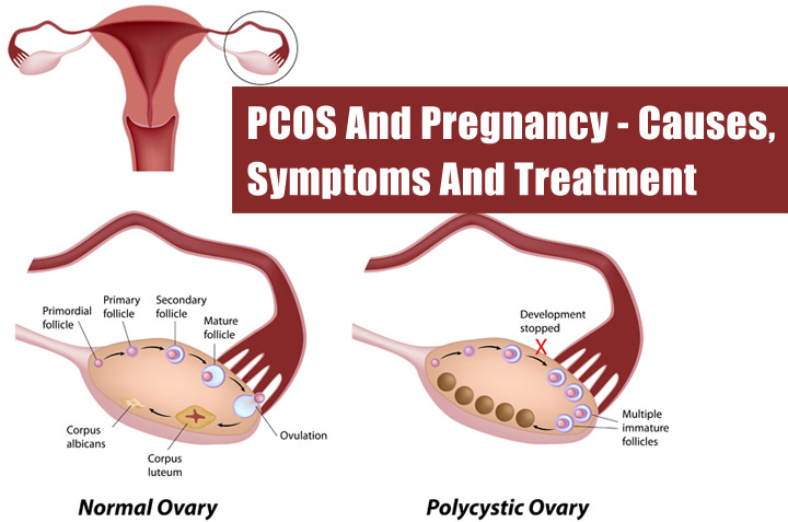 PCOS And Pregnancy