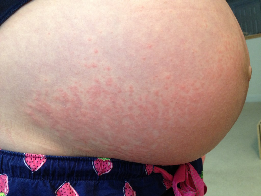 Skin Rash During Pregnancy