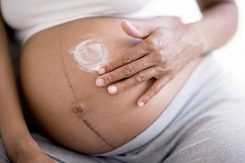 Stretch Marks In Pregnancy