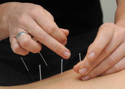 Acupuncture During Pregnancy 1