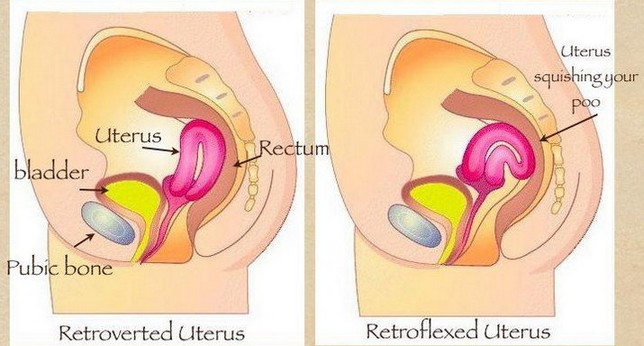 Tilted Uterus During Pregnancy 1