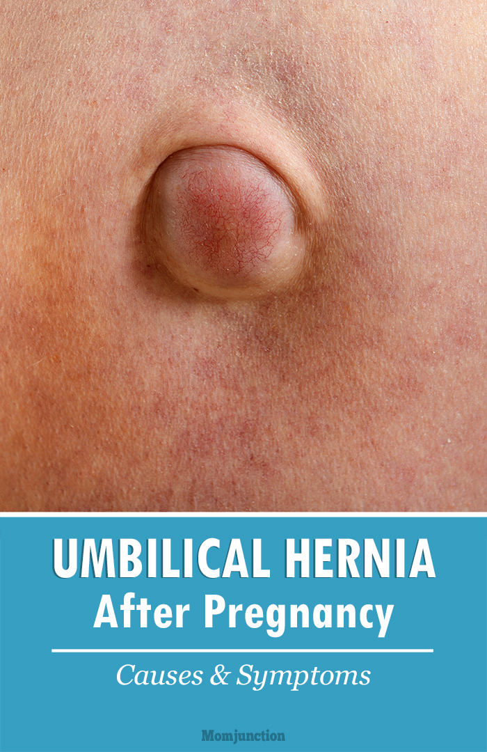 Hernia After Pregnancy 1