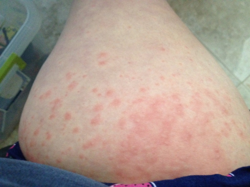 Itchy Legs During Pregnancy