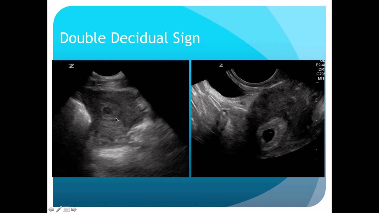 Ultrasound During Pregnancy 1