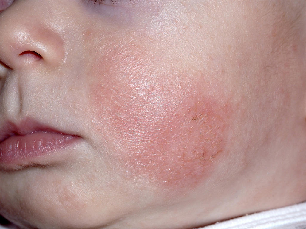 Baby Rash And Skin Conditions 1