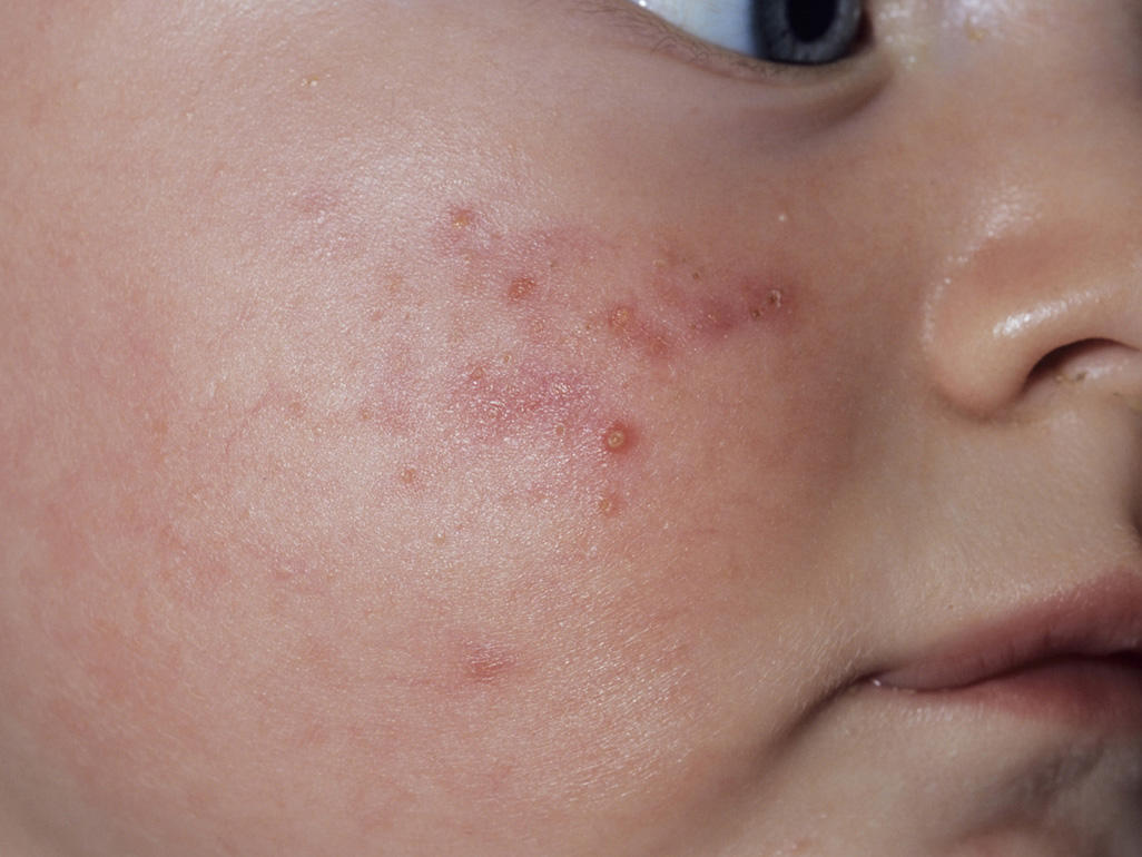 Baby Rash And Skin Conditions 2