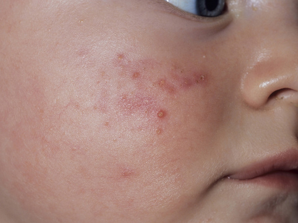 Baby Rash And Skin Conditions