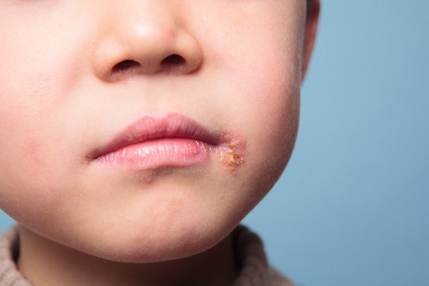Cold Sores In Children Herpes Types And Symptoms Prevention And