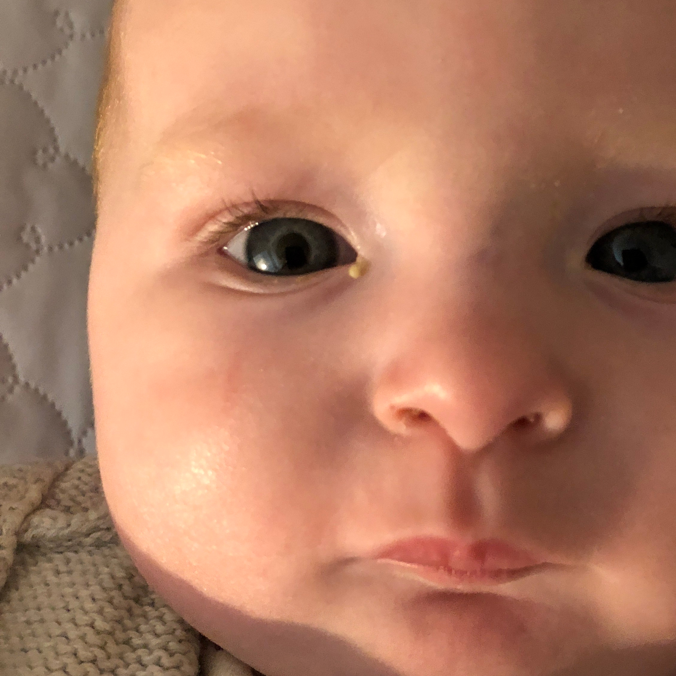 Conjunctivitis (Pinkeye) In Babies 1
