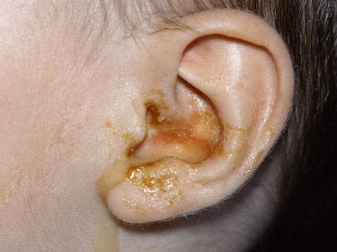 Ear Infections In Babies 1