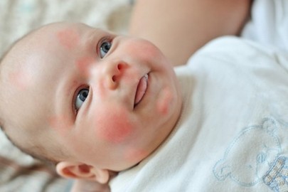 Food Allergies In Babies 1