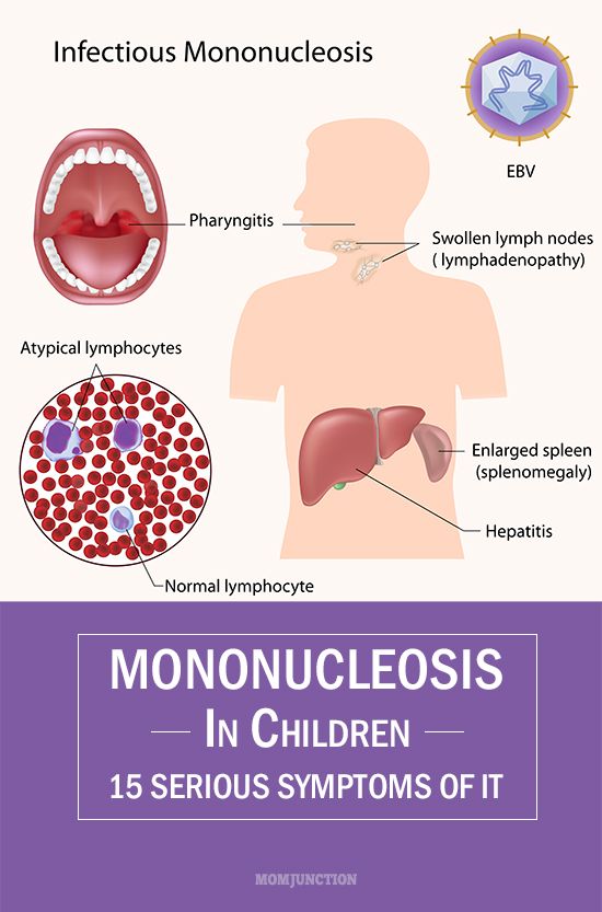 Mononucleosis In Children