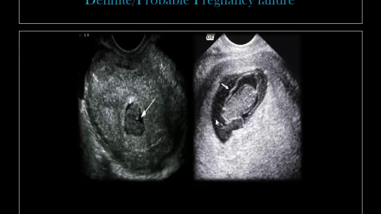 Abnormal Pregnancy 2