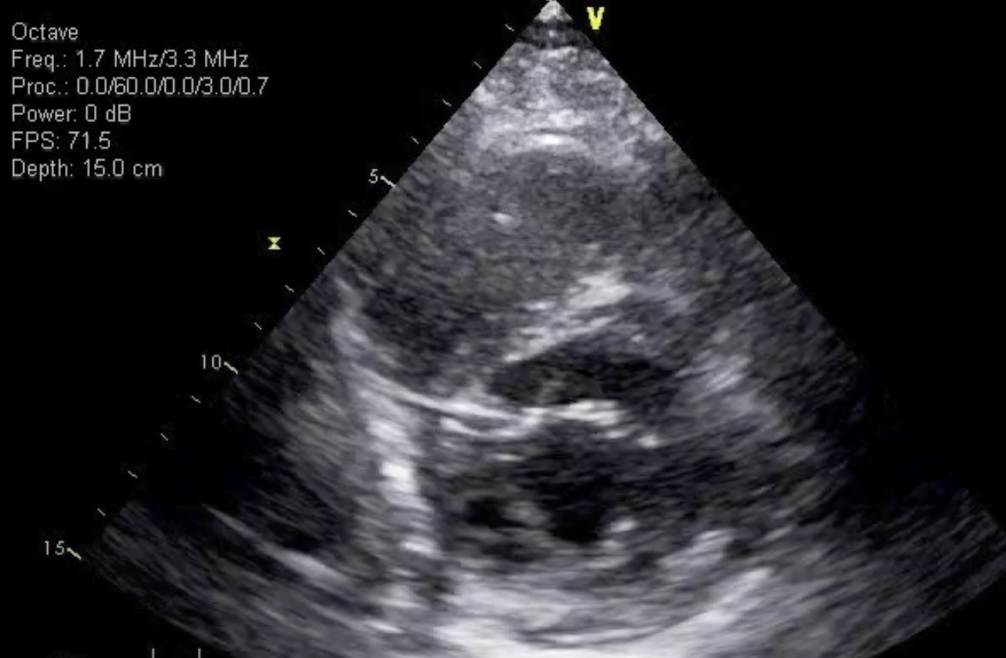 Tachycardia During Pregnancy 1