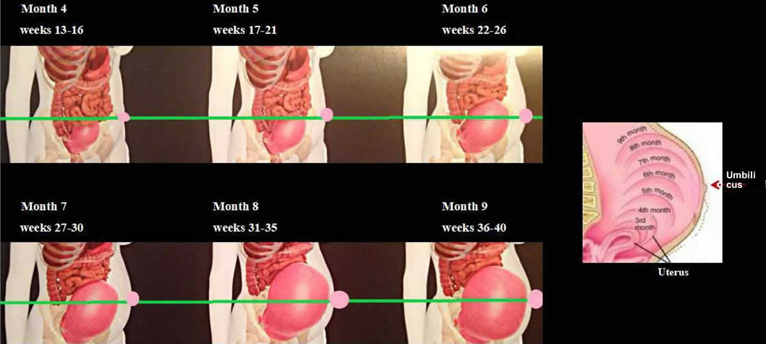 Umbilical Hernia In Pregnancy