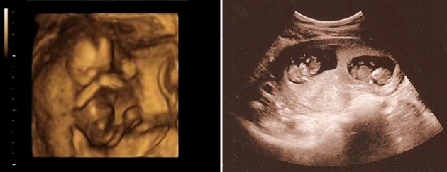 18 weeks ultrasound twins pictures