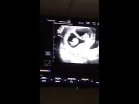ultrasound of twins at 2 months