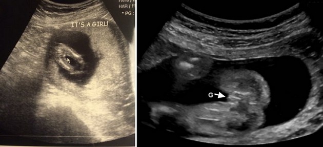 21 Week Ultrasound Girl