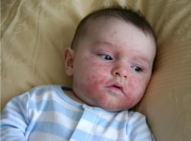 Impetigo rash on baby face