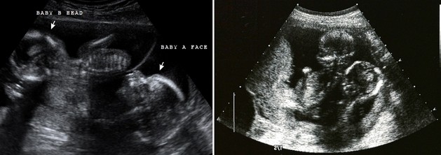 16 weeks ultrasound twins pictures