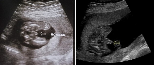 21 Week Ultrasound Boy