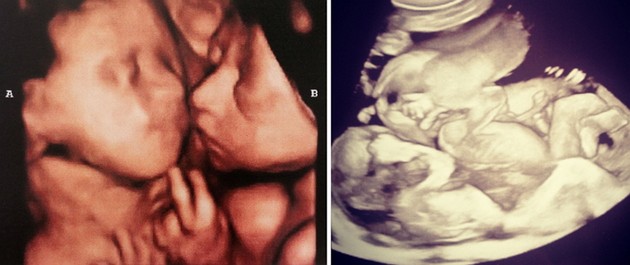25 weeks ultrasound twins pictures
