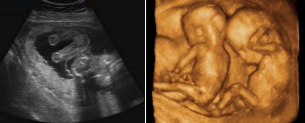 21 weeks ultrasound twins pictures
