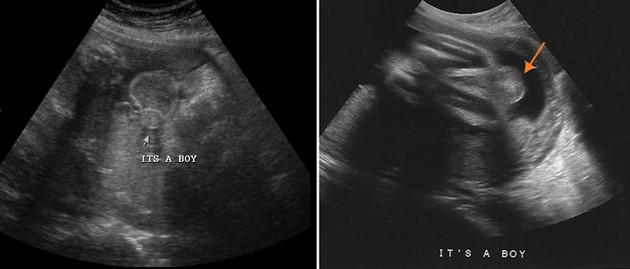 32 Week Ultrasound Boy