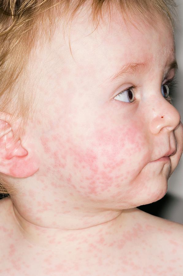 Measles rashes on baby neck