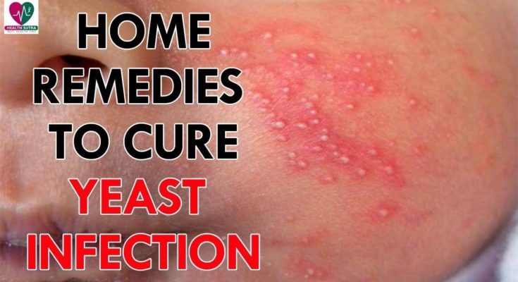 what causes yeast infection in babies