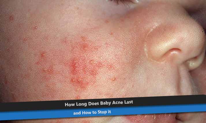 how long does baby acne last